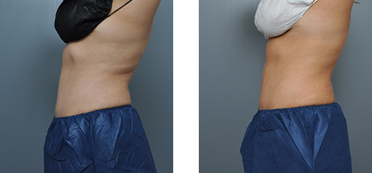 CoolSculpting Gallery | Williamson Cosmetic Center