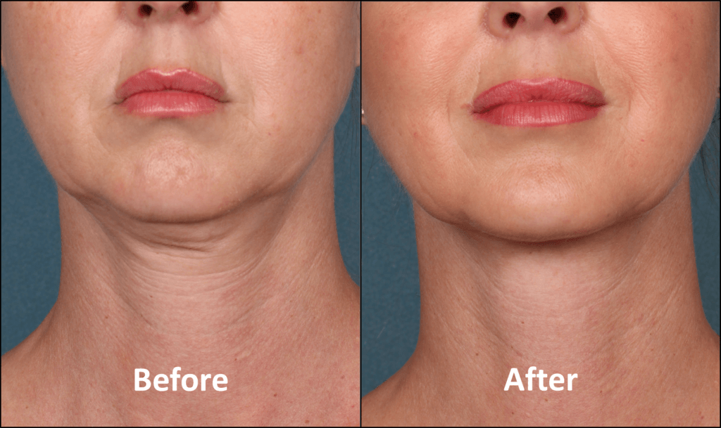 Kybella Before and After Results 