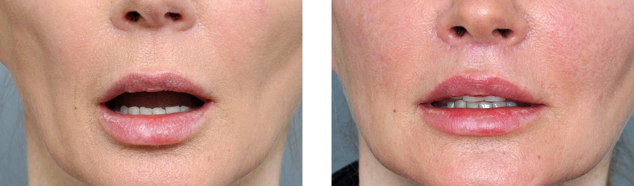 Lip Lift Gallery | Williamson Cosmetic Center | Before &amp; After
