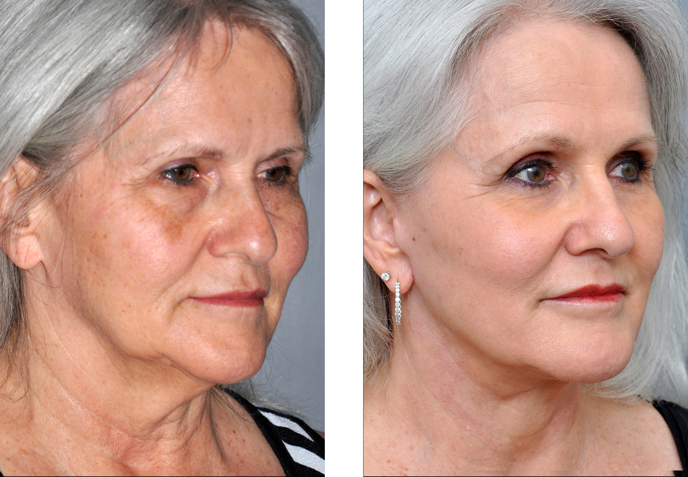 Skin Resurfacing Gallery | Williamson Cosmetic Center