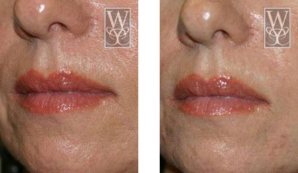 restylane before