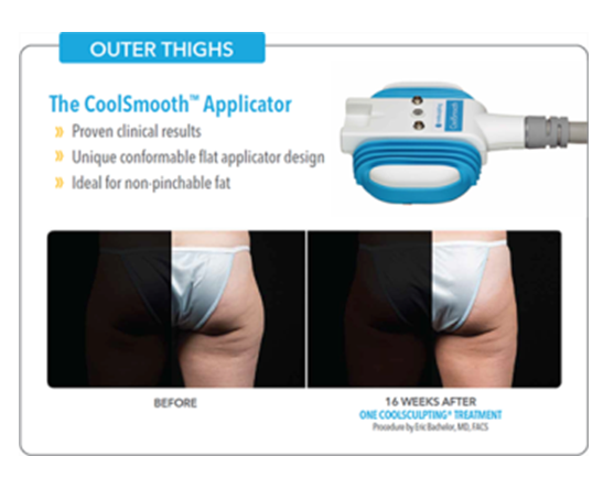 CoolSculpting results for thighs