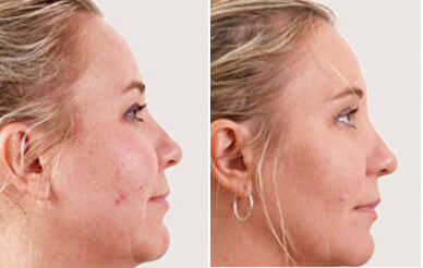 Exilis Before & After
