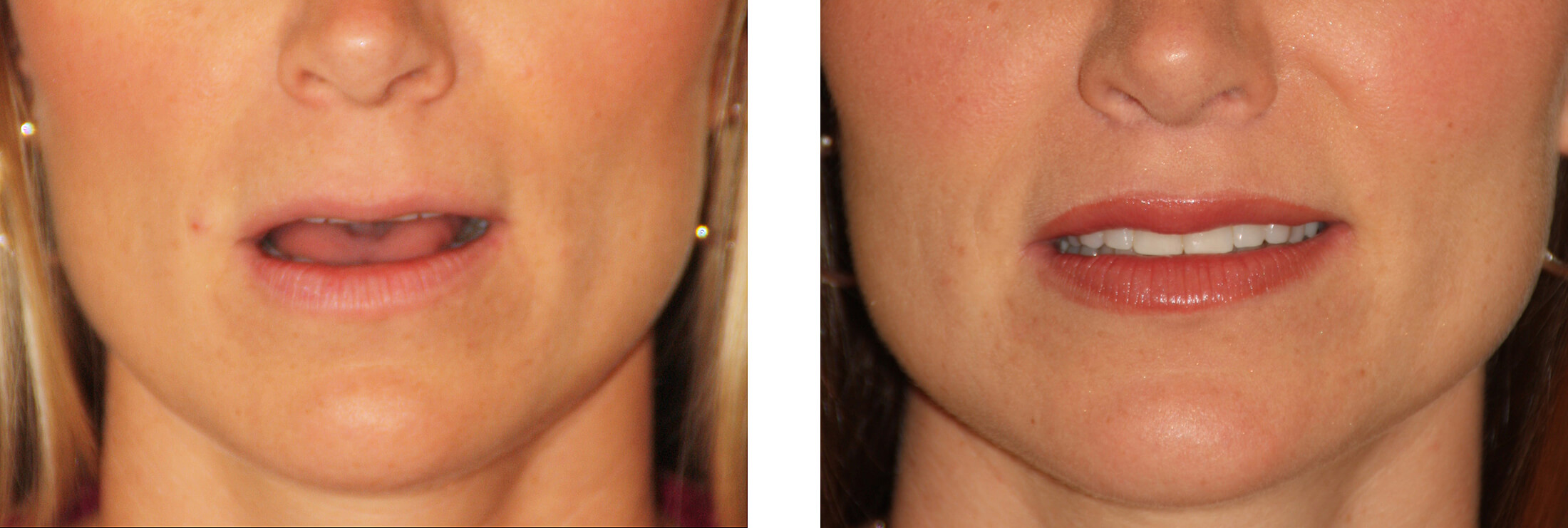 Lip Lift Before and After