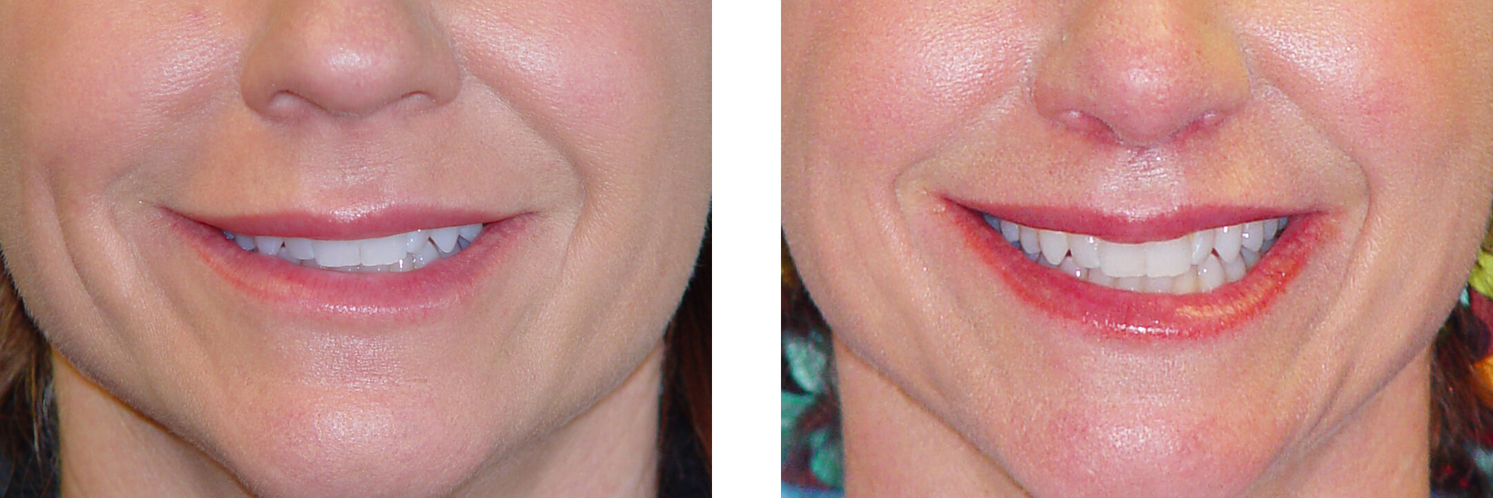 Lip Lift Before and After