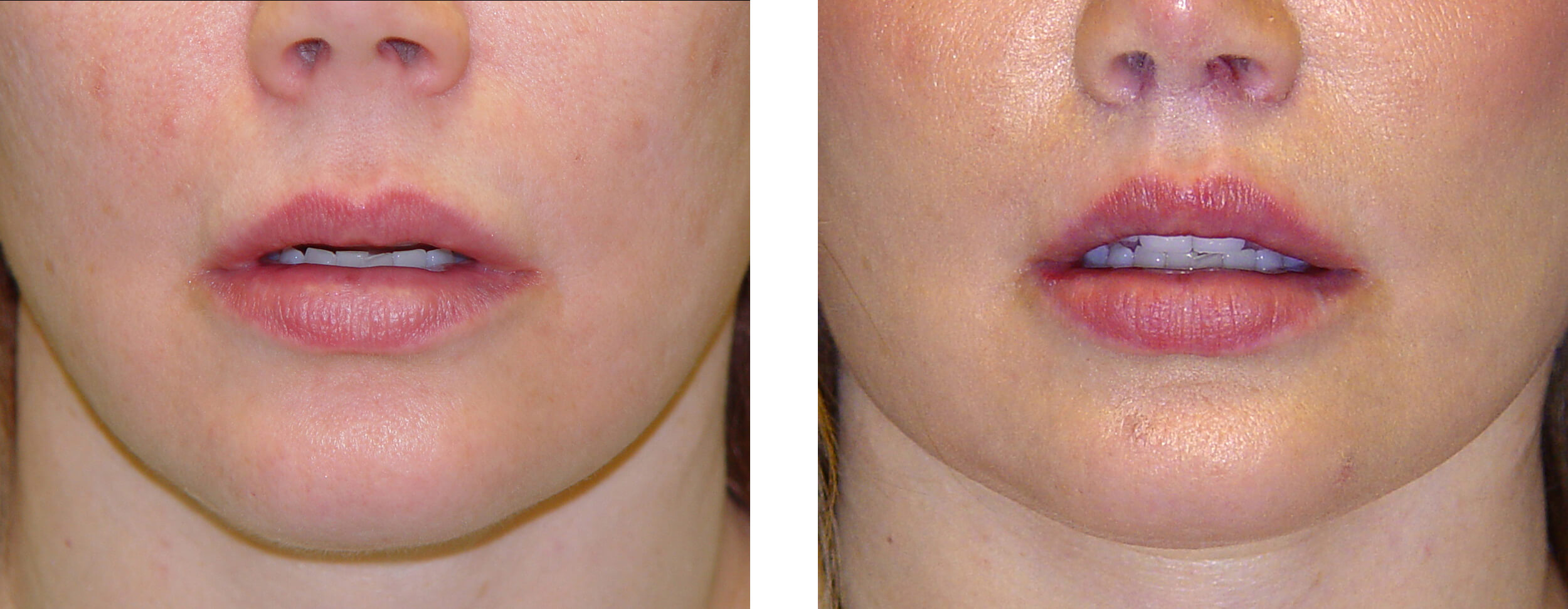 Lip Lift Before and After