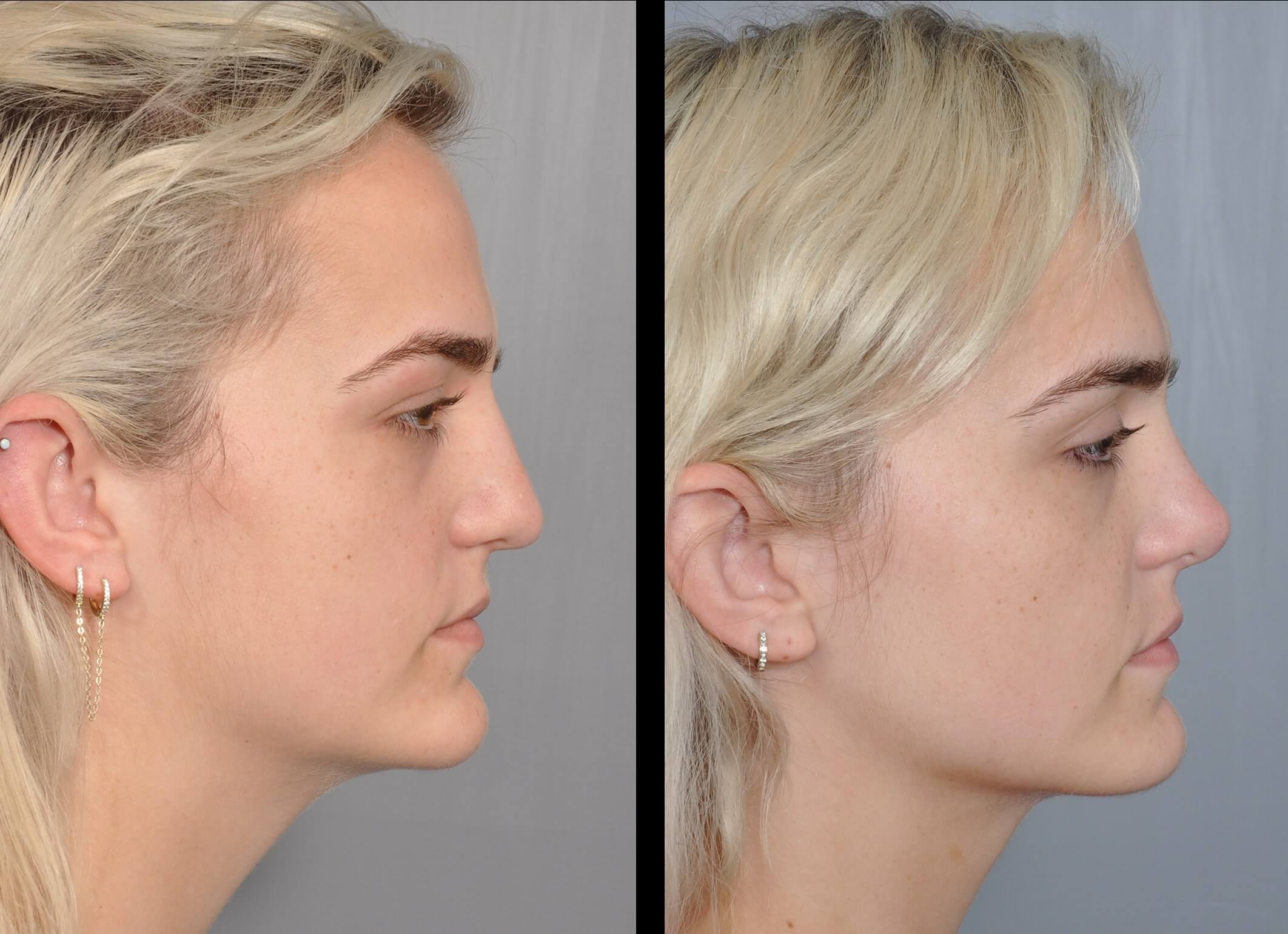 Chin Implant Baton Rouge Plastic Surgery Williamson Cosmetic Chin Implant Baton Rouge Plastic Surgery Williamson Cosmetic